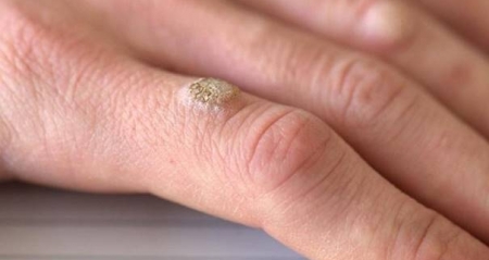 Điều trị hạt cơm bằng nitơ lỏng tại Bệnh viện Da Liễu TPHCM chi phí ra sao?