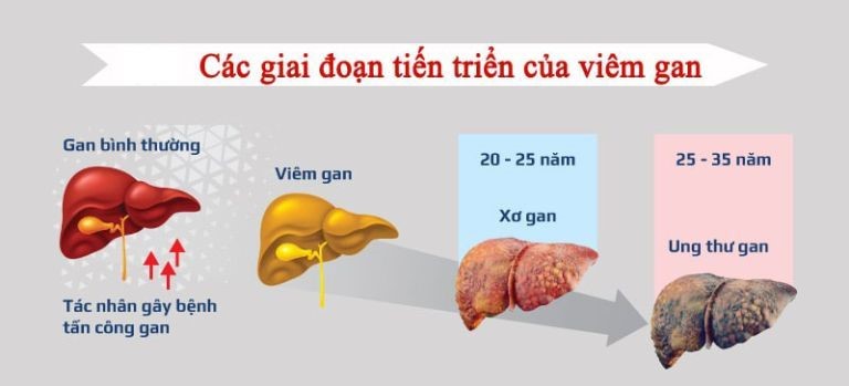 Viêm Gan B Có Nguy Hiểm Không? Những Điều Bạn Cần Biết